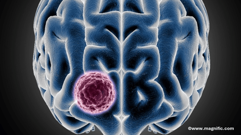 Cancer : la SATT Aquitaine investit dans un dispositif médical pour le traitement du glioblastome